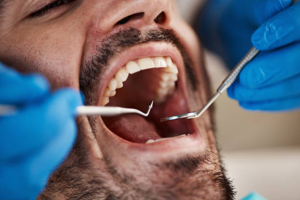 Best Knocked-Out Tooth (Avulsed Tooth) Treatment in Pine Island, MN
